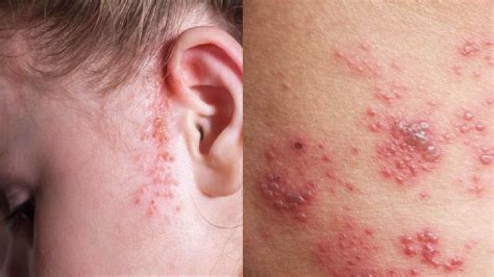 10 Rashes That Could Reveal a Dermatologic Disease &raquo; Types of rashes