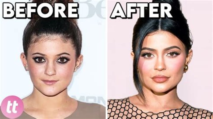 Before And After Plastic Surgery