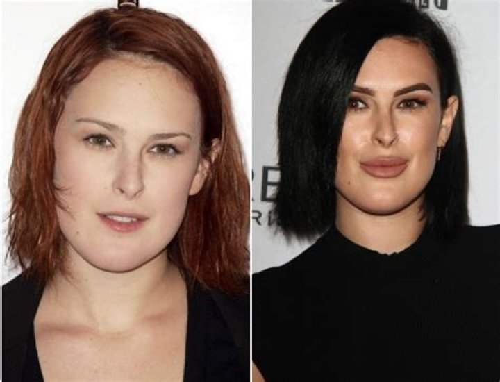 Celebrity Plastic Surgery: Rumer Willis's Transformation