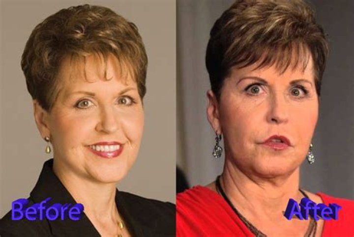 Joyce Meyer's Plastic Surgery Transformation: Before And After Revealed