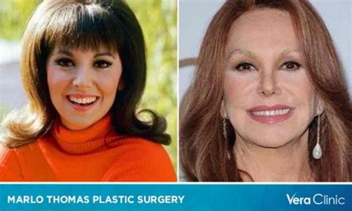 Marlo Thomas: Before & After Plastic Surgery