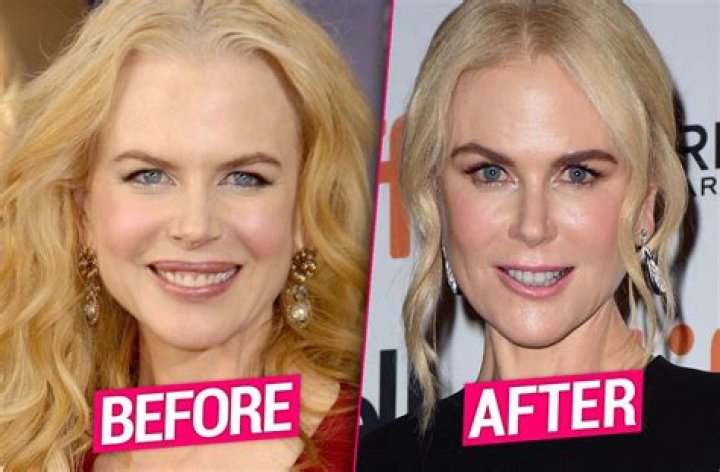 Nicole Kidman Plastic Surgery Facelift, Lip Augmentation, Breast increase