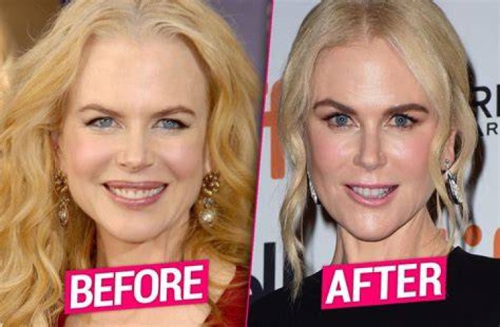 Nicole Kidman plastic surgery for puffy look