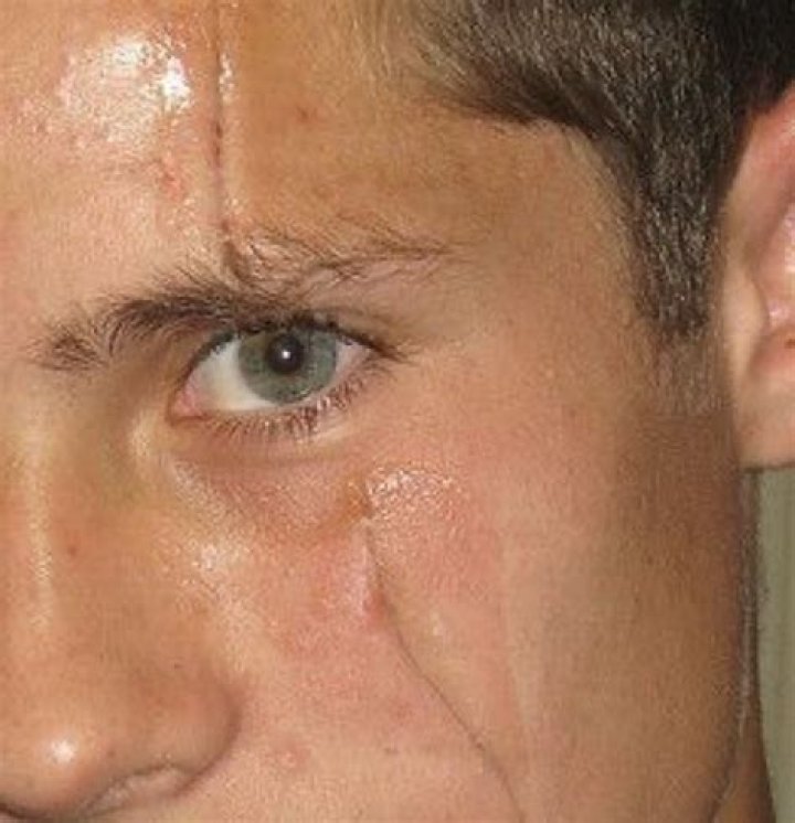 The Ultimate Guide To Julie Gonzalo's Facial Scar: History, Impact, And Treatment