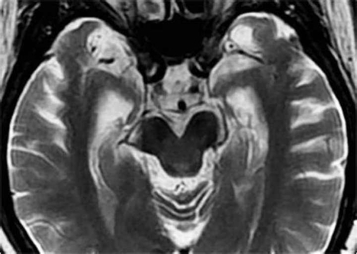 Unveiling Alzheimer's Impact: Tommy Lee Jones' Journey And Groundbreaking Insights