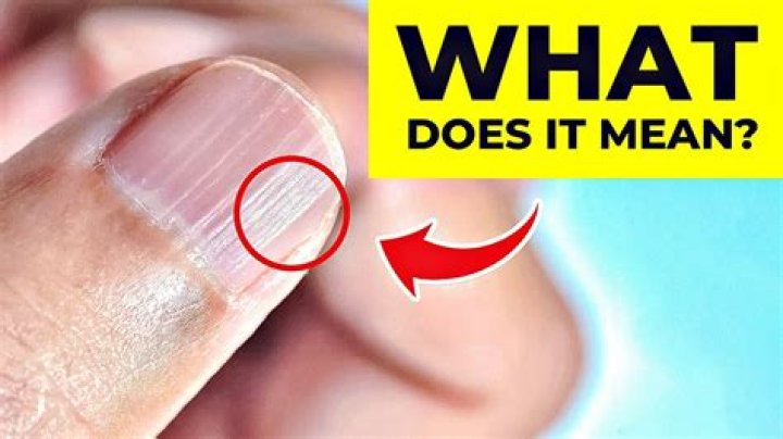 What Do Ridges In Your Nails Mean (2023)