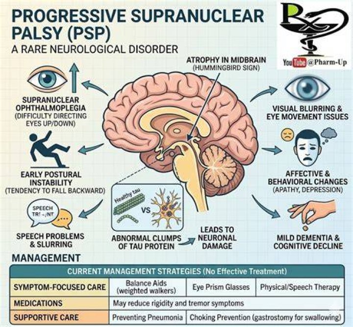 What Is PSP Disease? Progressive Supranuclear Palsy Signs Parade